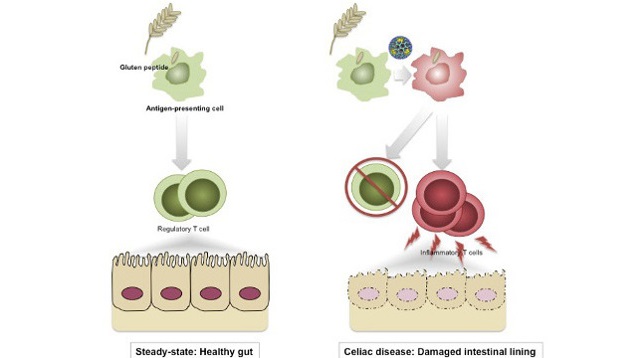 Viral Trigger for Celiac Disease? The Scientist Magazine®