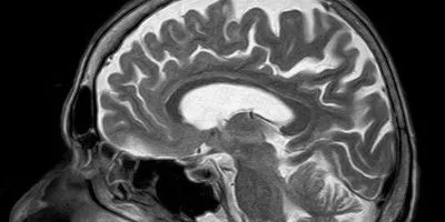 ADHD Linked to Structural Differences in the Brain | The Scientist