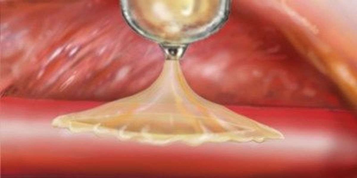 Next Generation Strong Surgical Glue On Demand The Scientist Magazine