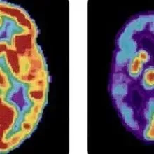 A Blood Test for Alzheimer’s? | The Scientist