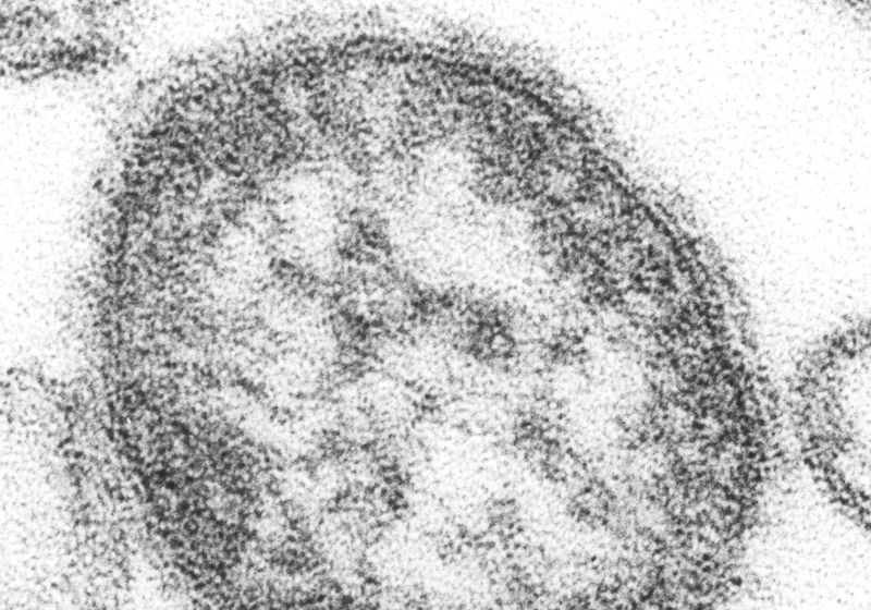 Measles Epidemic Rocks Madagascar