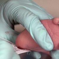 a drop of blood for a newborn's heel is placed on a piece of paper