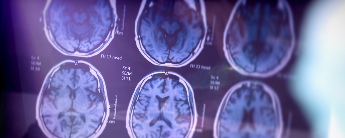 Apoe Mutation Linked To Protection From Alzheimer S Case Study