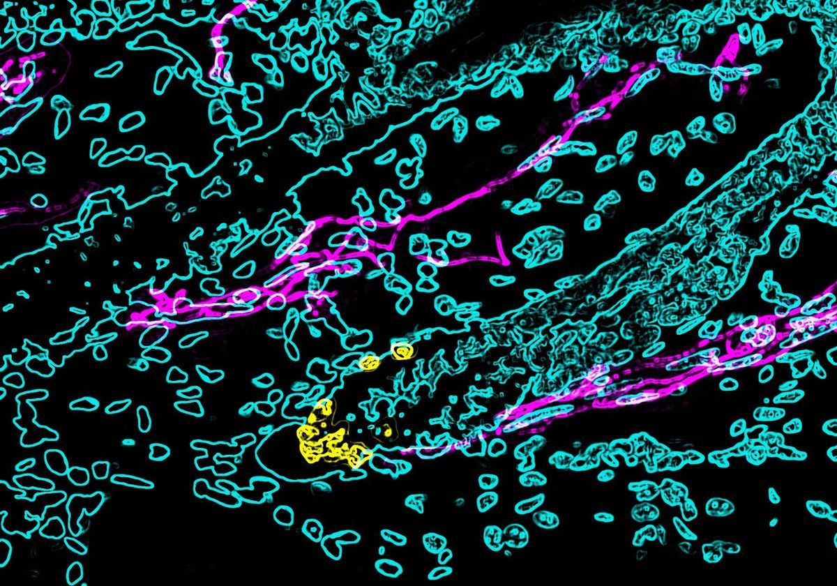 Stress Turns Hair Gray By Depleting Pigment Producing Stem Cells