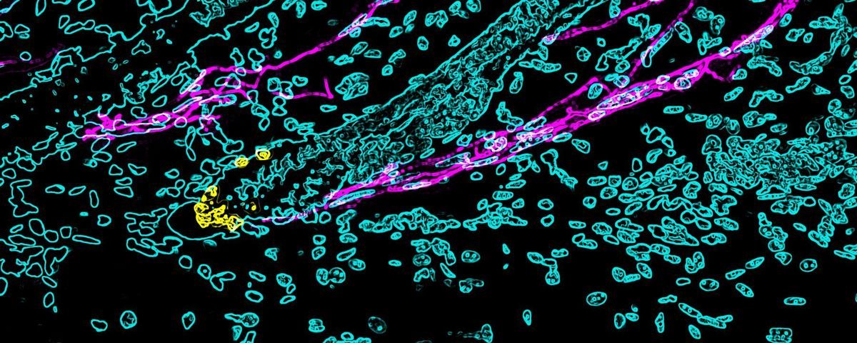 Stress Turns Hair Gray By Depleting Pigment Producing Stem Cells