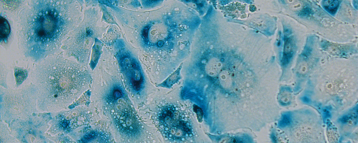 Can Destroying Senescent Cells Treat Age Related Disease The