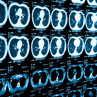 ct scan lung covid-19 pneumonia coronavirus pandemic sars-cov-2 ground glass opacity