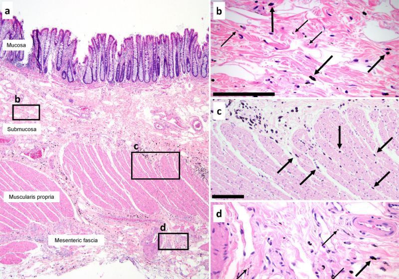 Cancer Cells Could Travel Through the Interstitium: Study | The Scientist