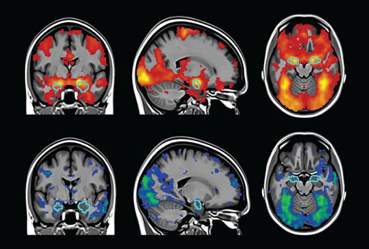 Fmri Brain Scan
