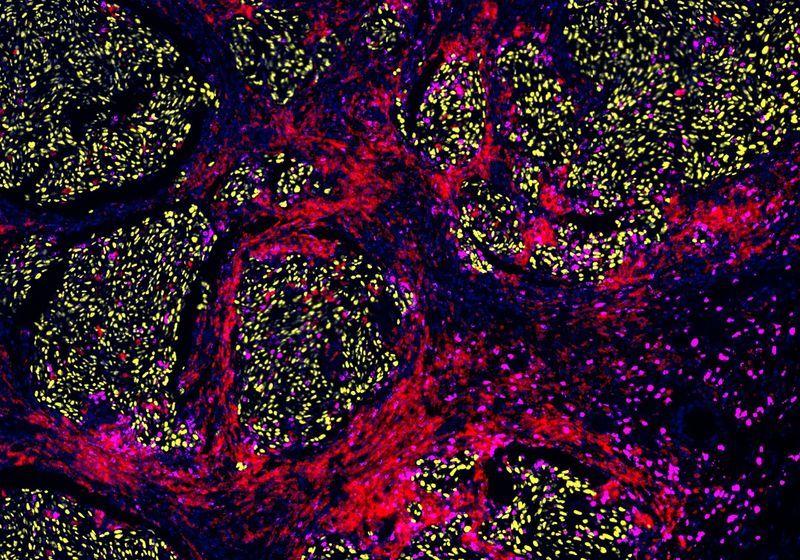 Cross-Resistance: One Cancer Therapy Can Undermine the Next