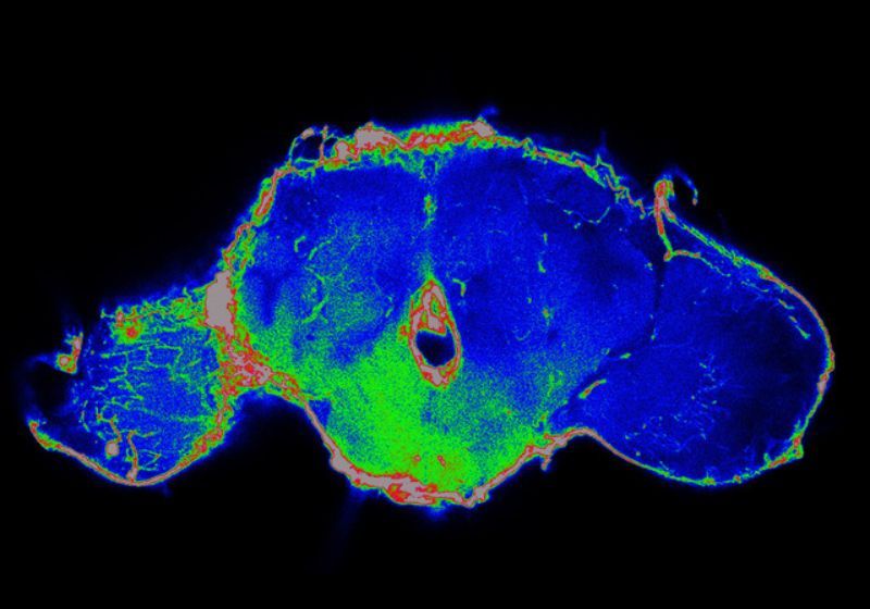 Tumors Disrupt the Blood-Brain Barrier at a Distance
