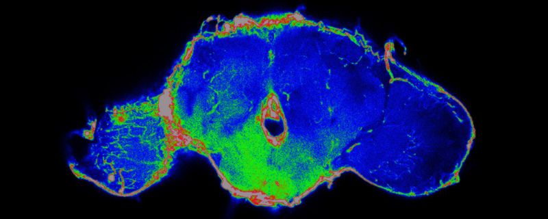 Tumors Disrupt the Blood-Brain Barrier at a Distance