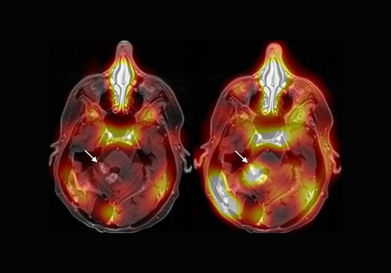 Sound Waves Aid Brain Tumor Treatment The Scientist Magazine®