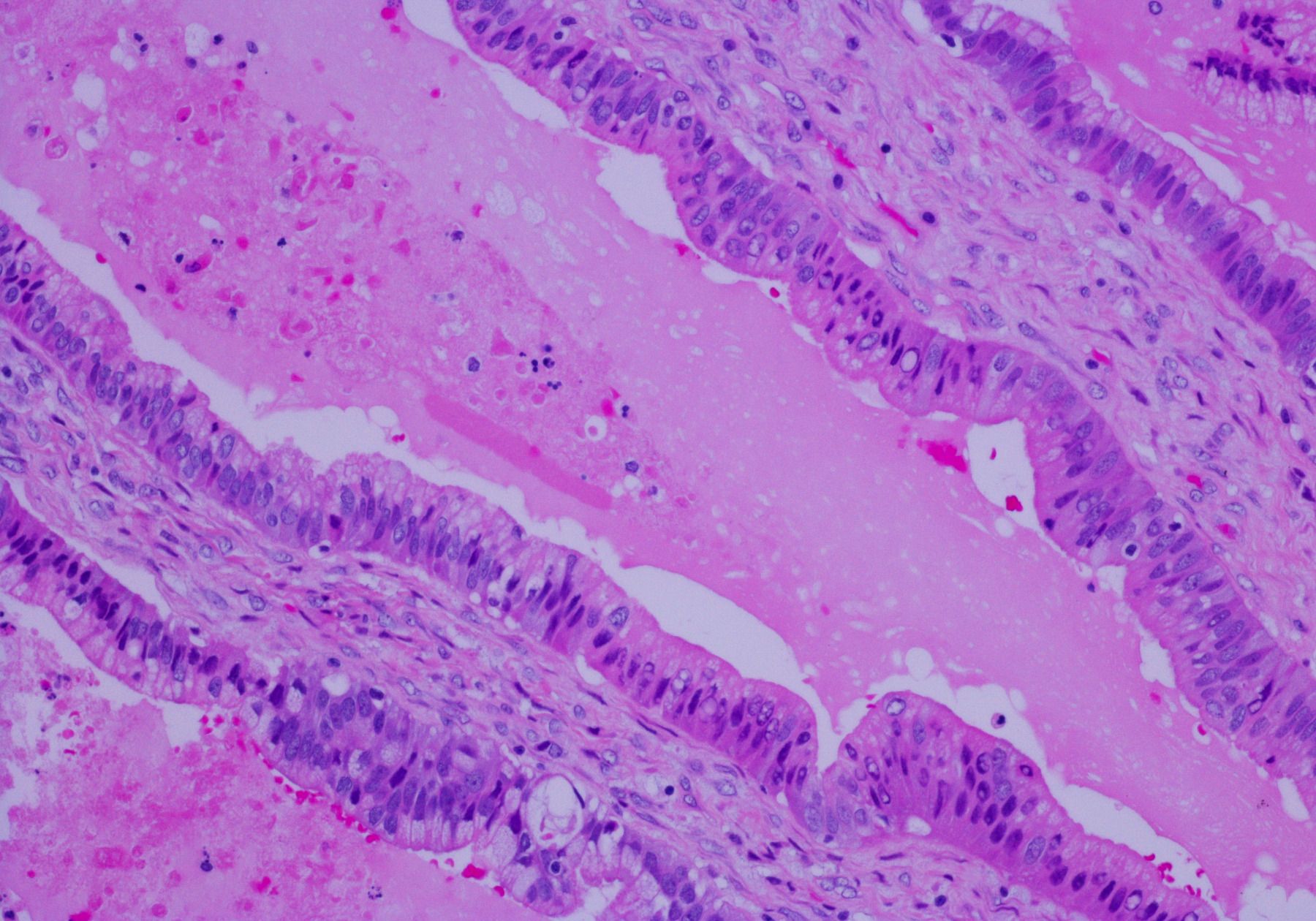 Pancreatic Cancer Cells