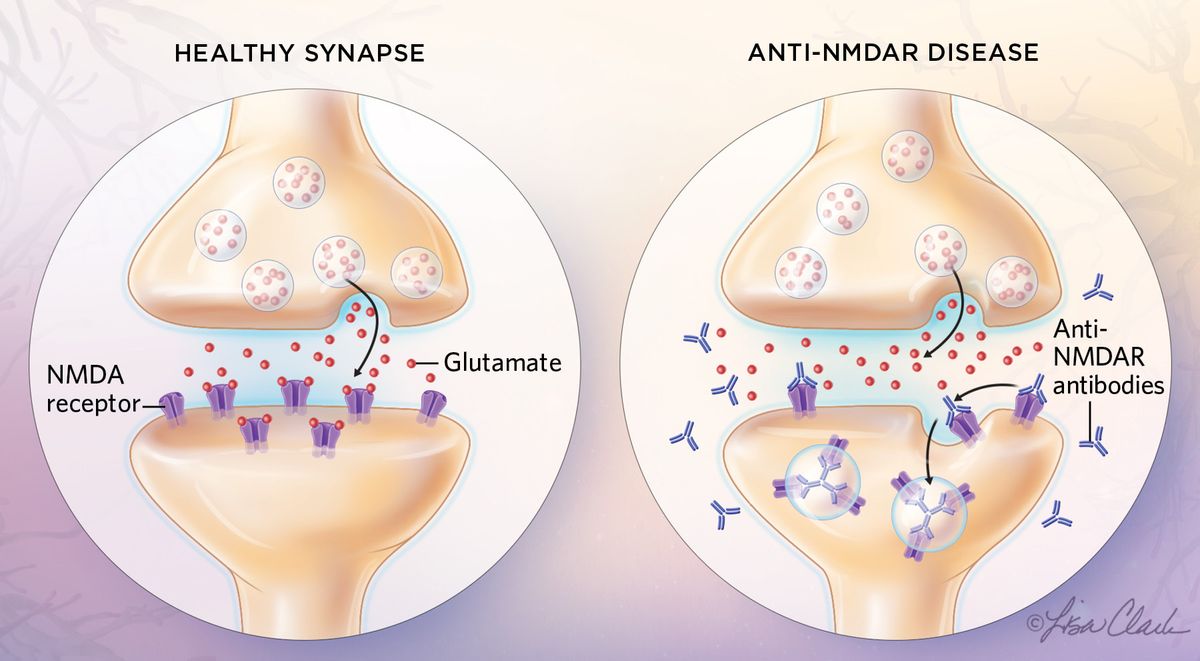 Illustration comparing healthy synapse and anti-NMDAR disease