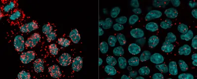 Mutated Cohesin Throws DNA Splicing out of Whack, Resulting in Cancer ...