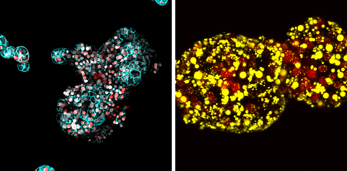 A normal human liver organoid (left) stained with blue and red next to a fatty liver organoid (right) with lipid droplets stained yellow.