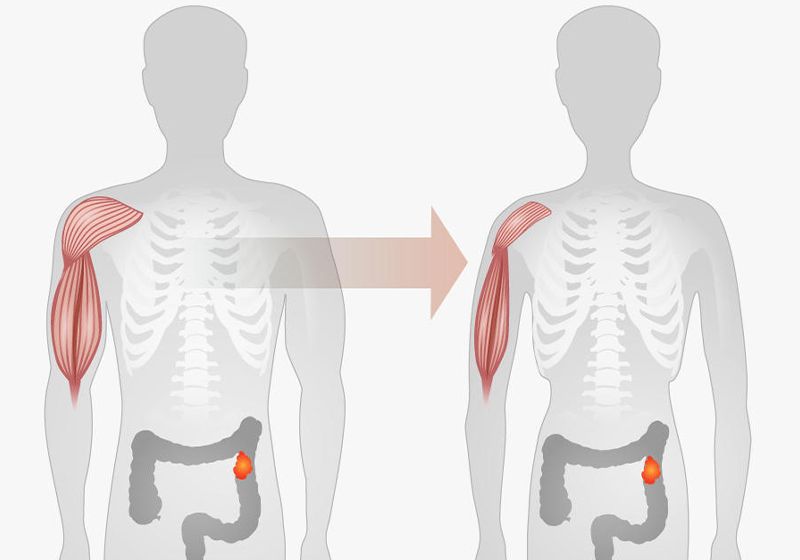 The Neural Circuitry Driving Cancer-Related Wasting Disease | The