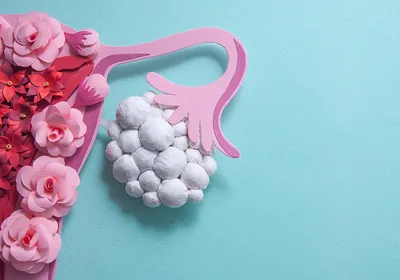 An artistic rendition of polycystic ovarian syndrome, showing ovarian cysts represented by paper balls. An artistic rendition of polycystic ovarian syndrome, showing ovarian cysts represented by paper balls.