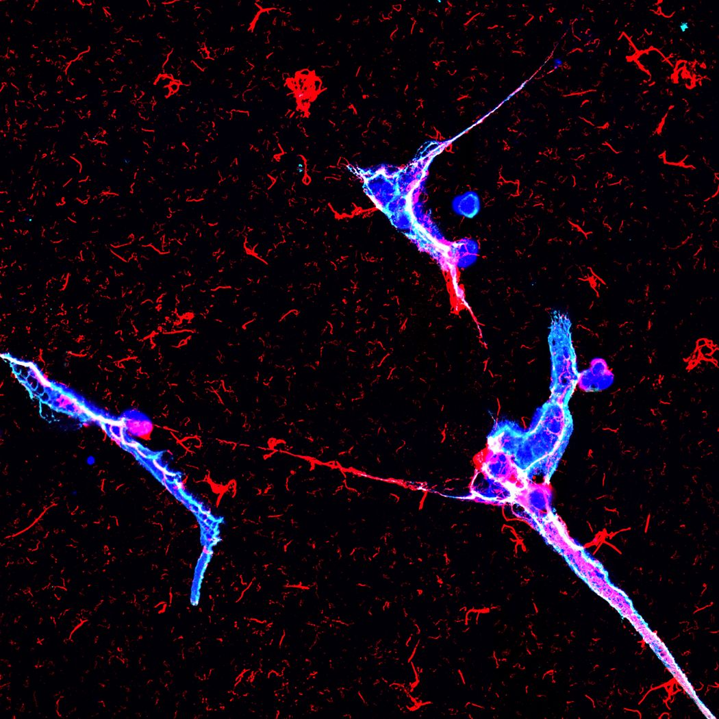 Large webs of DNA ejected by neutrophils (blue) and studded with cytotoxic protein (red) entrap bacteria (pink) in human urine.
