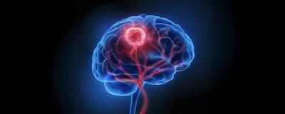 A transparent, blue 3D model of the human brain glows against a darker blue background. A glowing pink and red tumor sits in the center of the brain, with red tendrils surrounding it and gathering at the base of the brain.