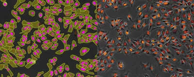 Two images of U2OS cells transfected with a fluorescently labeled protein. The left panel shows AI-based analysis of transfection efficiency, with cells bounded in yellow and label marked in magenta. The right panel shows baseline fluorescence. Two images of U2OS cells transfected with a fluorescently labeled protein. The left panel shows AI-based analysis of transfection efficiency, with cells bounded in yellow and label marked in magenta. The right panel shows baseline fluorescence.