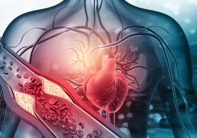 Human heart with a partially blocked blood vessel, illustrating the role of lipoprotein(a) in cardiac diseases.