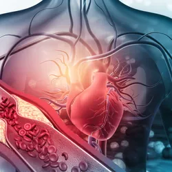 Human heart with a partially blocked blood vessel, illustrating the role of lipoprotein(a) in cardiac diseases.
