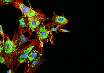 Fluorescent microscopy image of metastatic cancer cells