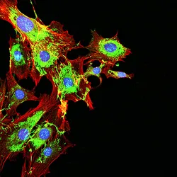 Fluorescent microscopy image of metastatic cancer cells