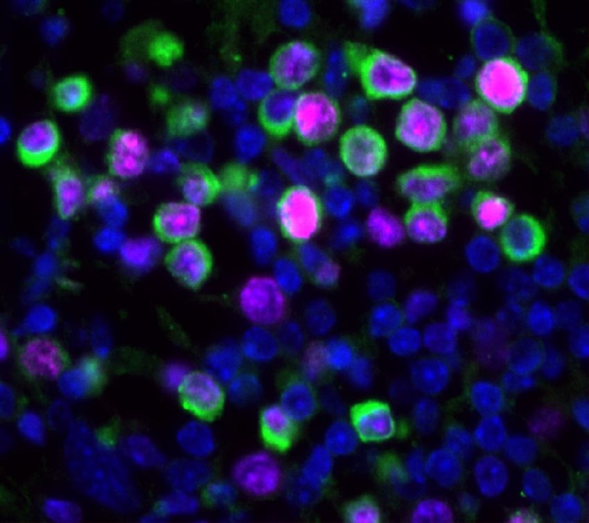 Fluorescent image of lung and cancer cells (blue). Some cells are ringed in green, depicting the cancerous cells. Pink staining identifies those cells that are actively dividing.