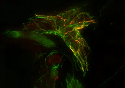 Microscopy image of a skin biopsy showing fluorescent green nerve fibers and areas of orange/gold representing phosphorylated alpha-synuclein with nerve fibers surrounding a blood vessel. Microscopy image of a skin biopsy showing fluorescent green nerve fibers and areas of orange/gold representing phosphorylated alpha-synuclein with nerve fibers surrounding a blood vessel.