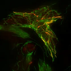 Microscopy image of a skin biopsy showing fluorescent green nerve fibers and areas of orange/gold representing phosphorylated alpha-synuclein with nerve fibers surrounding a blood vessel.