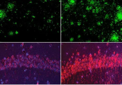Image of four panels. In the top panel, amyloid clusters are labeled green. There are more green clusters in the rightmost box. In the bottom panel, there is a dim arc of purple and red tau proteins on the left and a brighter arc on the right. Image of four panels. In the top panel, amyloid clusters are labeled green. There are more green clusters in the rightmost box. In the bottom panel, there is a dim arc of purple and red tau proteins on the left and a brighter arc on the right.
