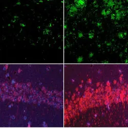 Image of four panels. In the top panel, amyloid clusters are labeled green. There are more green clusters in the rightmost box. In the bottom panel, there is a dim arc of purple and red tau proteins on the left and a brighter arc on the right. Image of four panels. In the top panel, amyloid clusters are labeled green. There are more green clusters in the rightmost box. In the bottom panel, there is a dim arc of purple and red tau proteins on the left and a brighter arc on the right.