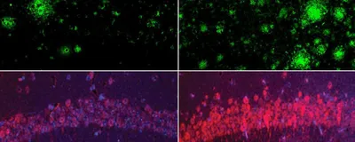 Image of four panels. In the top panel, amyloid clusters are labeled green. There are more green clusters in the rightmost box. In the bottom panel, there is a dim arc of purple and red tau proteins on the left and a brighter arc on the right.