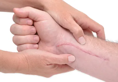 Two hands massage an arm with a long scar running along the length.