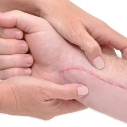 Two hands massage an arm with a long scar running along the length.