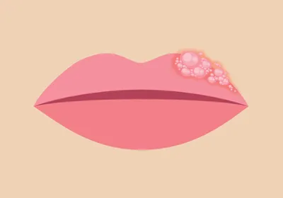 Cartoon close-up of a human face with the nose and lips in frame. There are boils on the top left part of the lip, indicating a cold sore breakout. Cartoon close-up of a human face with the nose and lips in frame. There are boils on the top left part of the lip, indicating a cold sore breakout.