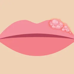 Cartoon close-up of a human face with the nose and lips in frame. There are boils on the top left part of the lip, indicating a cold sore breakout.