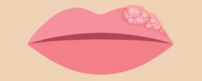 Cartoon close-up of a human face with the nose and lips in frame. There are boils on the top left part of the lip, indicating a cold sore breakout. 