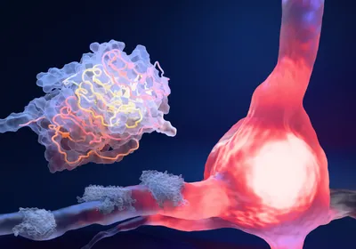 3D illustration of a neuron with the cell body highlighted in pink to represent damage from an amyloid β plaque on its axons to the left. An enlarged plaque bundle is shown in the top left corner of the image, with the fibrils highlighted in pink and yellow. 3D illustration of a neuron with the cell body highlighted in pink to represent damage from an amyloid β plaque on its axons to the left. An enlarged plaque bundle is shown in the top left corner of the image, with the fibrils highlighted in pink and yellow.