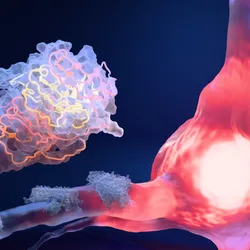 3D illustration of a neuron with the cell body highlighted in pink to represent damage from an amyloid β plaque on its axons to the left. An enlarged plaque bundle is shown in the top left corner of the image, with the fibrils highlighted in pink and yellow. 3D illustration of a neuron with the cell body highlighted in pink to represent damage from an amyloid β plaque on its axons to the left. An enlarged plaque bundle is shown in the top left corner of the image, with the fibrils highlighted in pink and yellow.