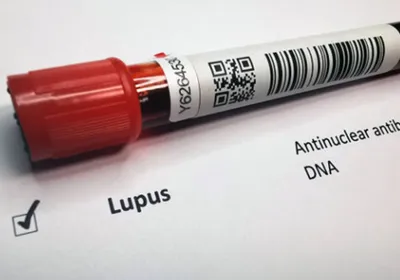 A vial of a patient's serum is sent for autoantibody detection during lupus testing 
