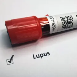 A vial of a patient's serum is sent for autoantibody detection during lupus testing 