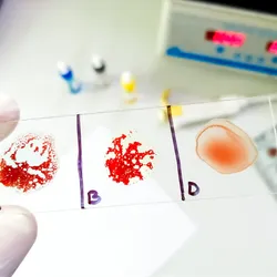 A gloved hand holding a slide containing an agglutination test for AB negative rare blood group.