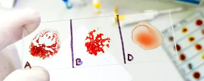 A gloved hand holding a slide containing an agglutination test for AB negative rare blood group.