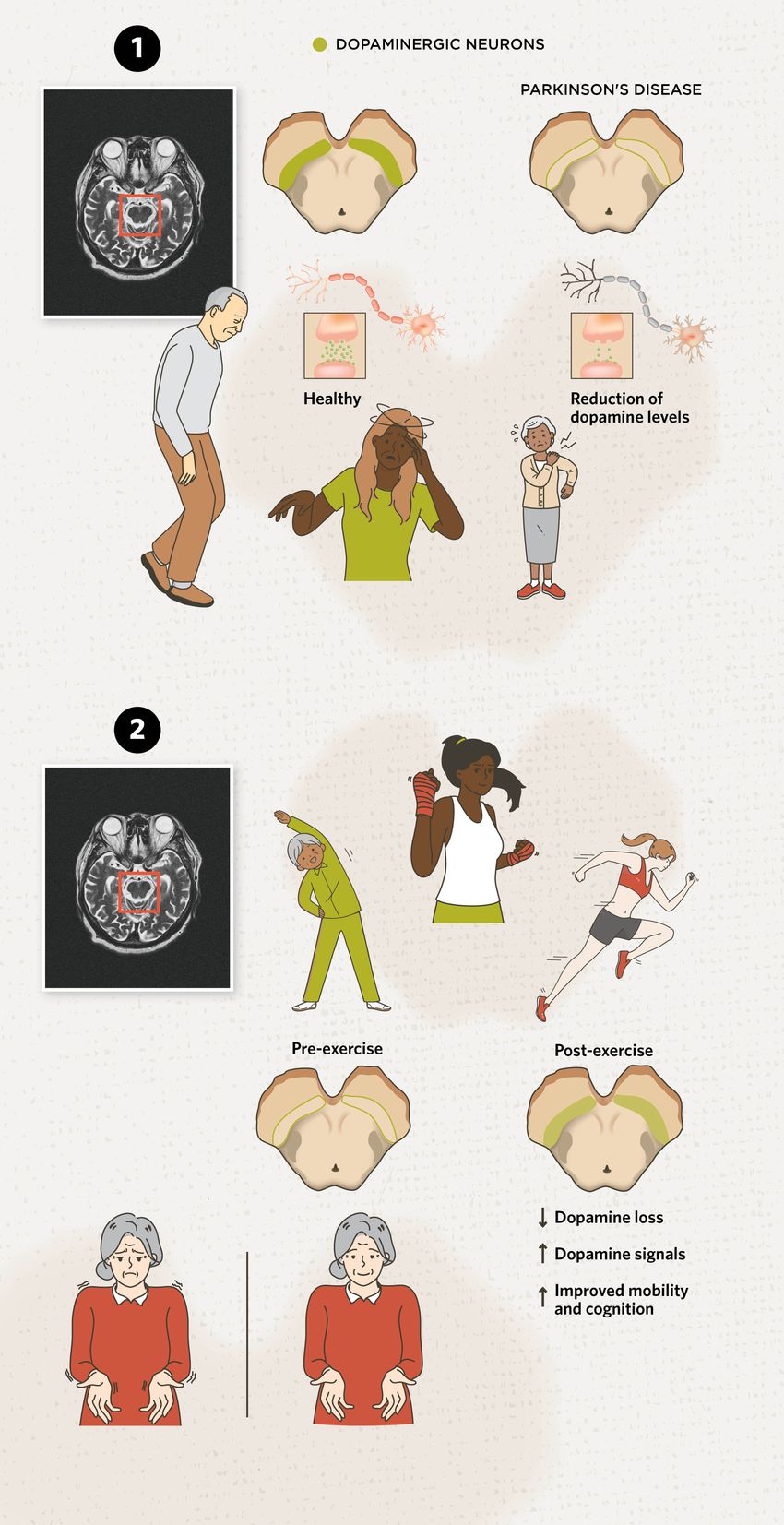 Two-part image. Top: Brain scan highlighting the substantia nigra, showing reduced dopaminergic neurons in Parkinson’s disease compared to healthy individuals. Bottom: Illustration of how exercise helps preserve neurons and dopamine in the substantia nigra, improving Parkinson’s symptoms.