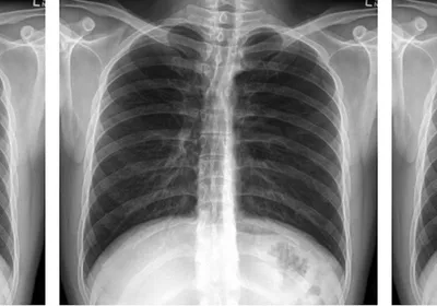 A panel of three abdominal X-rays that look exactly the same, indicating that the authors of the retracted paper likely copied the image to publish it as their own. A panel of three abdominal X-rays that look exactly the same, indicating that the authors of the retracted paper likely copied the image to publish it as their own.