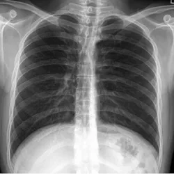 A panel of three abdominal X-rays that look exactly the same, indicating that the authors of the retracted paper likely copied the image to publish it as their own. A panel of three abdominal X-rays that look exactly the same, indicating that the authors of the retracted paper likely copied the image to publish it as their own.